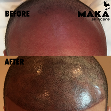 Male - Hair Loss Treatment 3D Combination Microblading