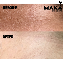 Chemical Peel - MAKASkincare