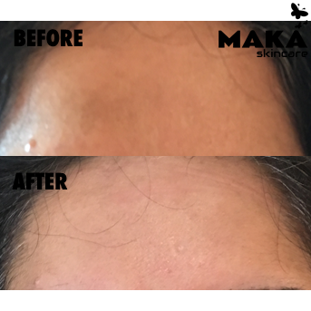 Chemical Peel - MAKASkincare