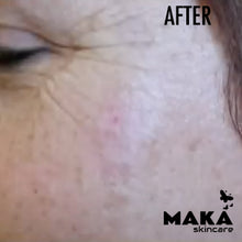 MAKASkincare - CryoPen