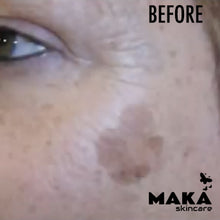 MAKASkincare - CryoPen