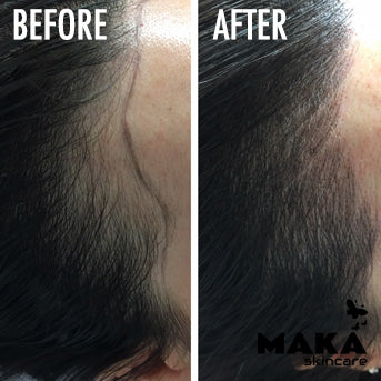 Female Hairloss Microblading | South Woodford | Mayfair