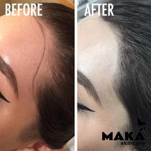 Female Hairloss Microblading | South Woodford | Mayfair
