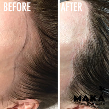 Female Hairloss Microblading | South Woodford | Mayfair
