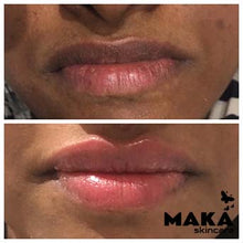 Derma Filler Treatments