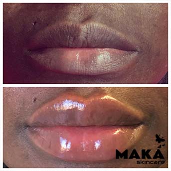 Derma Filler Treatments