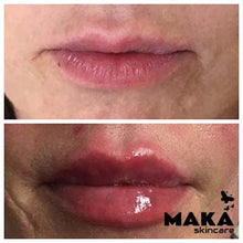 Derma Filler Treatments