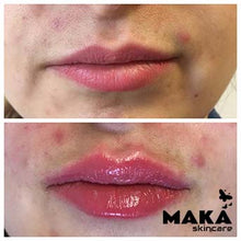 Derma Filler Treatments