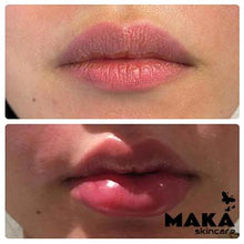 Derma Filler Treatments