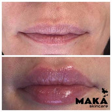 Derma Filler Treatments