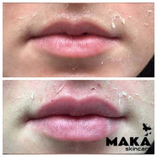 Derma Filler Treatments