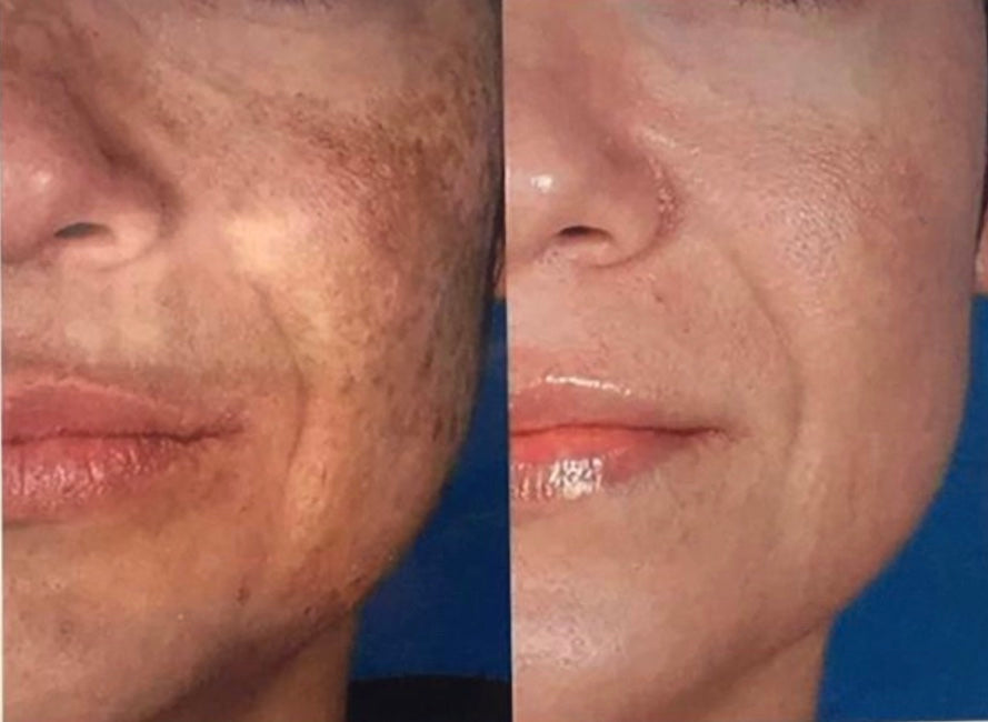 Glutathione Injection