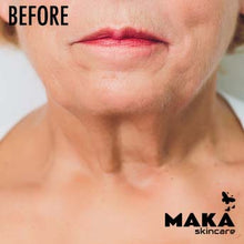 MAKASkincare - PDO Treatment