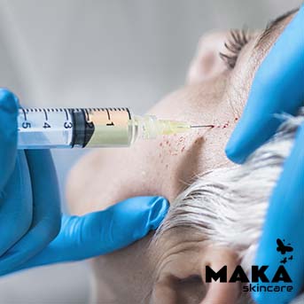 PRP | Platelet Rich Plasma | South Woodford | Mayfair | MAKASkincare