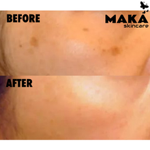 Skin Pigmentation Correction