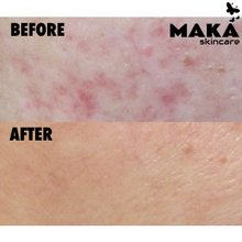 Derma Peel - MAKASkincare Clinic