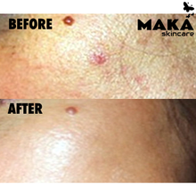 Derma Peel - MAKASkincare Clinic