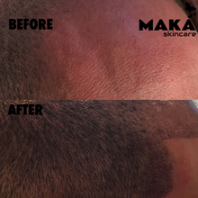Male - Hair Loss Treatment 3D Combination Microblading