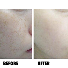 Oxygen Micro Bubble Aqua Peel - MAKASkincare