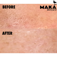 Chemical Peel - MAKASkincare