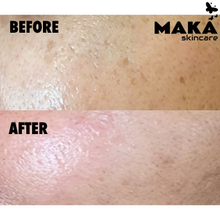 Chemical Peel - MAKASkincare