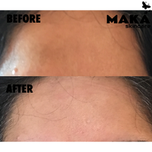 Chemical Peel - MAKASkincare