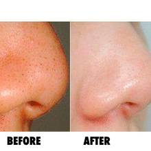 Oxygen Micro Bubble Aqua Peel - MAKASkincare