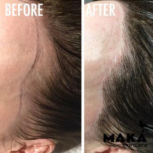 Female Hairloss Microblading | South Woodford | Mayfair