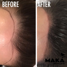 Female Hairloss Microblading | South Woodford | Mayfair