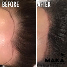 Female Hairloss Microblading | South Woodford | Mayfair