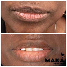 Derma Filler Treatments