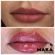 Derma Filler Treatments