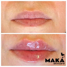 Derma Filler Treatments