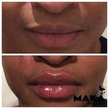 Derma Filler Treatments