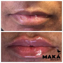 Derma Filler Treatments