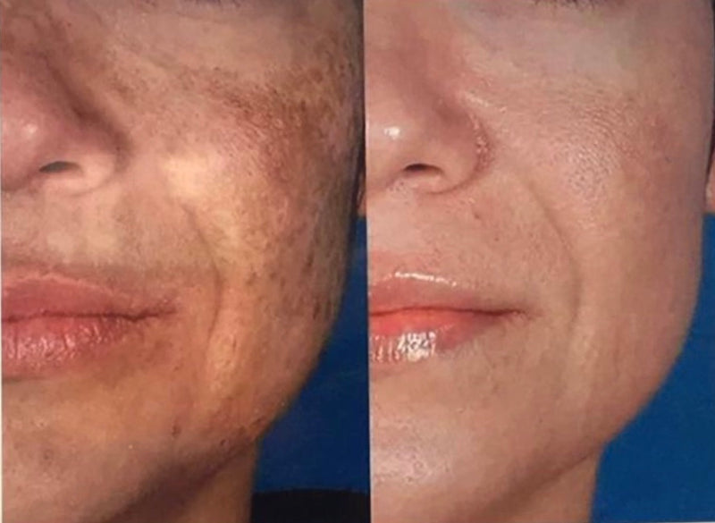 does glutathione injection work permanently Glutathione Injection