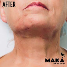 MAKASkincare - PDO Treatment