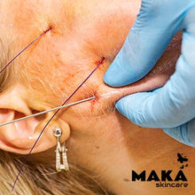 MAKASkincare - PDO Treatment