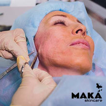 MAKASkincare - PDO Treatment
